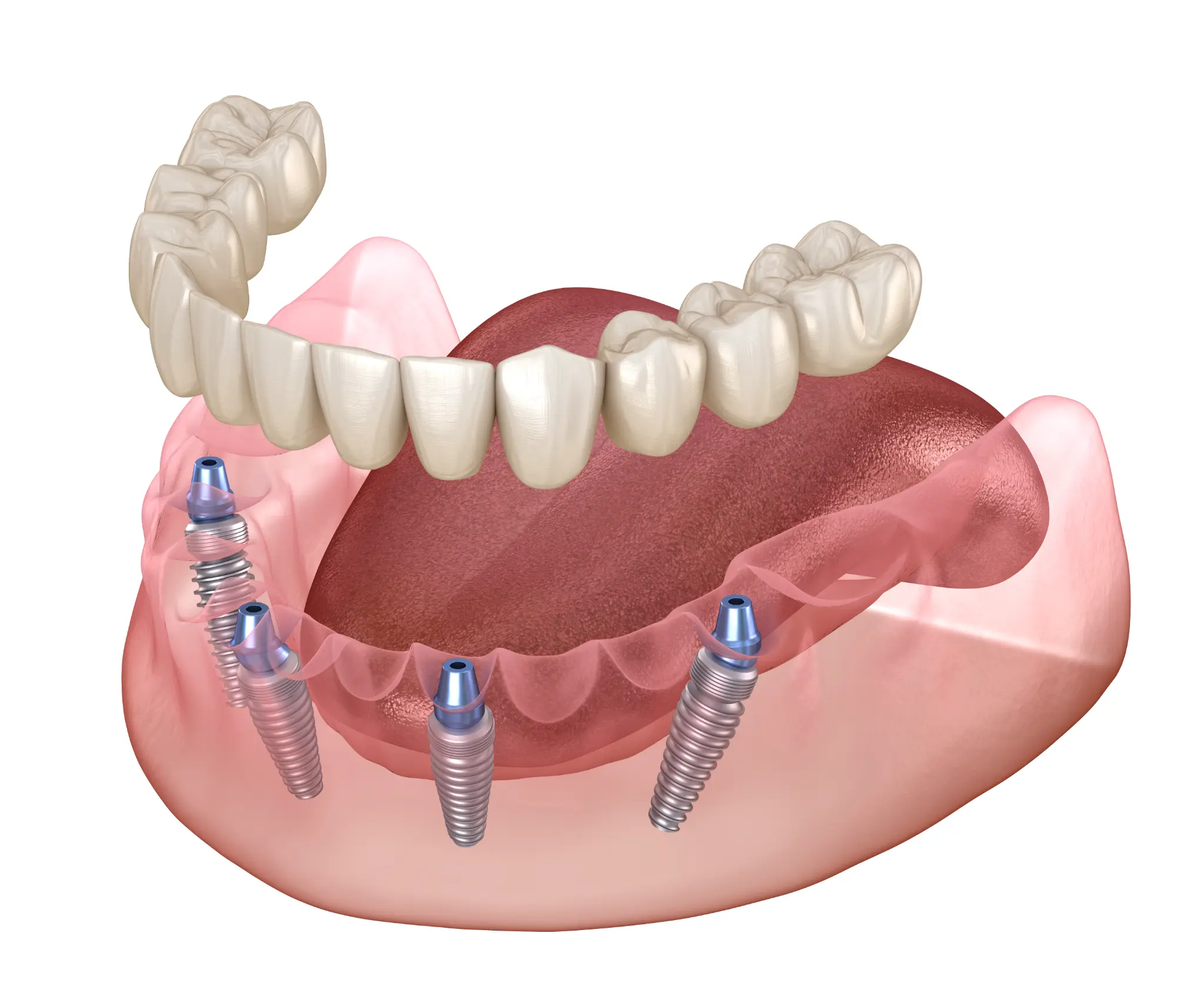 Three-dimensional model showing an All-on-X implant-retained denture